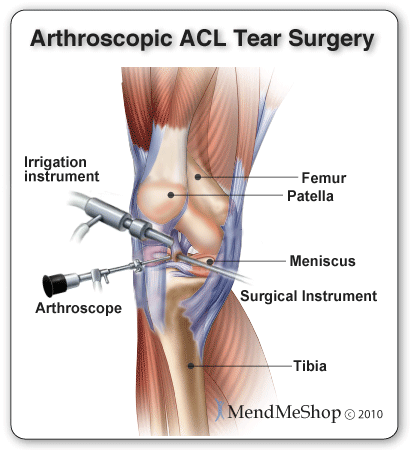 ACL (anterior cruciate ligament) tear arthroscopic surgery