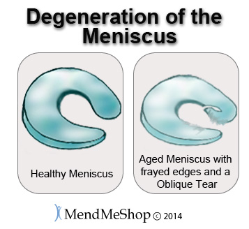 lateral meniscus degeneration
