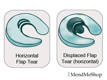 Horizontal tear and more severe displaced horizontal flap tear