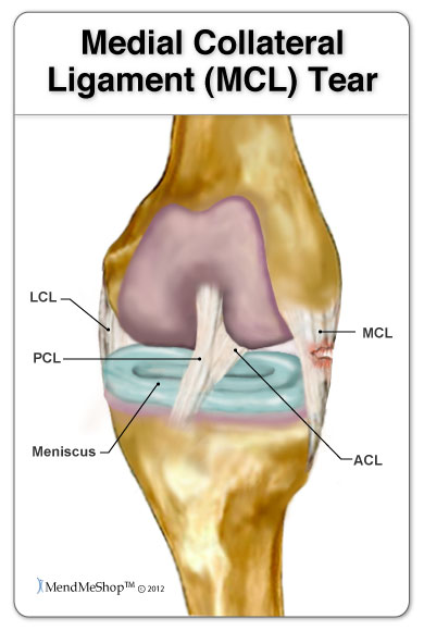 Illustration MCL tear anatomy knee