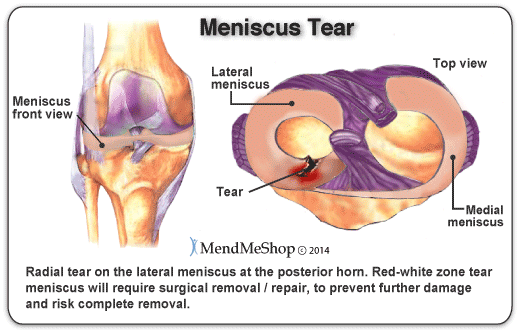 Lateral meniscus tears are more likely to be radial or oblique.