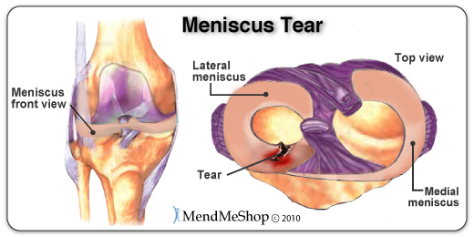 Lateral Meniscus and Medial Meniscus of the Knee
