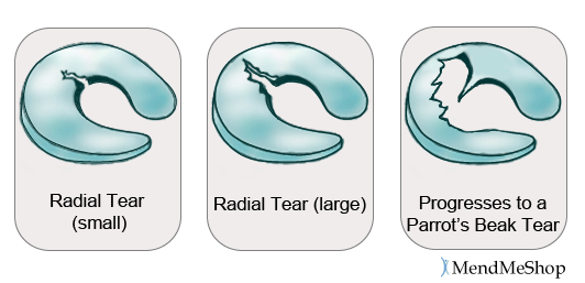 Radial tear and more severe Parrot's Beak tear