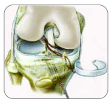 A meniscus may be replaced with an allograft or collagen implant