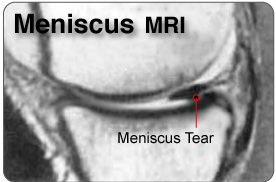 lateral meniscus mri